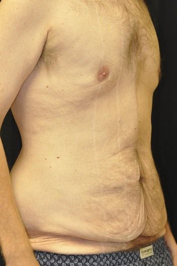 Tummy Tuck before and after - before
