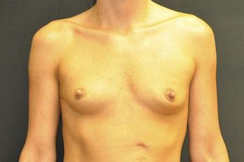 Breast Augmentation before and after - before