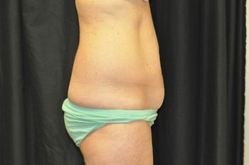 Tummy Tuck before and after - before