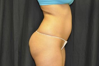 Liposuction before and after - before
