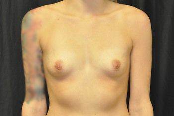 Breast Augmentation before and after - before