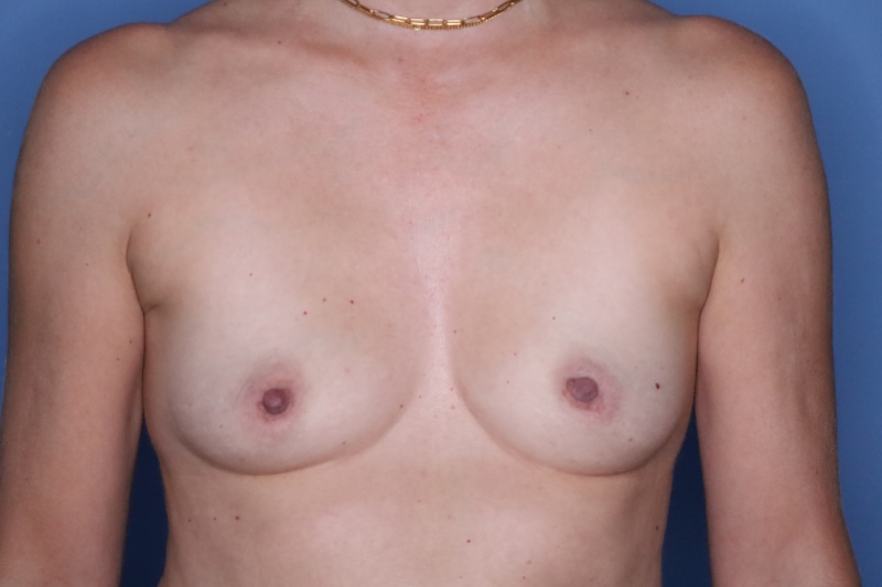 Breast Augmentation before and after - before