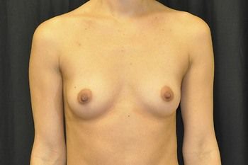 Breast Augmentation by Dr. Andrew Smith — before and after