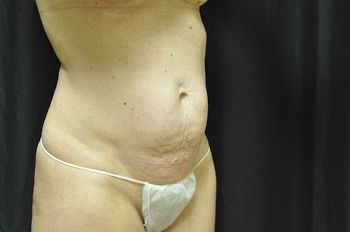 Tummy Tuck before and after - before