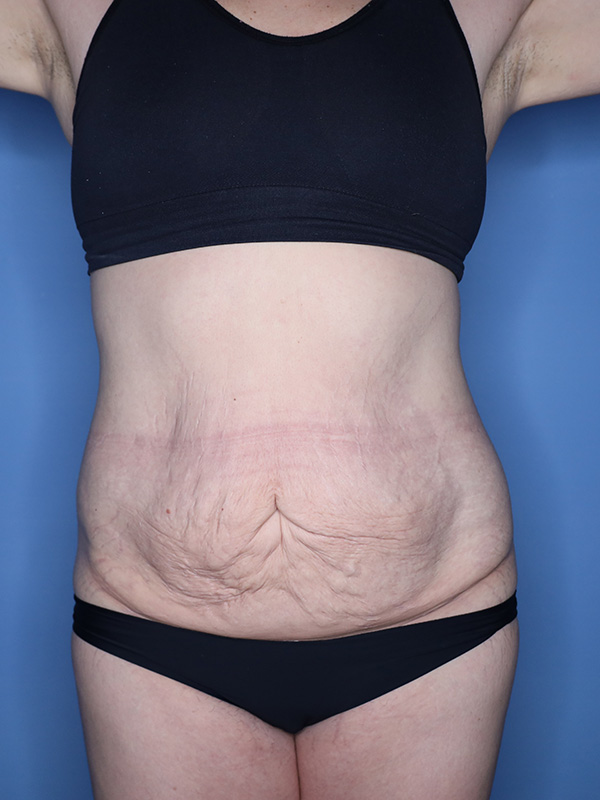 Tummy Tuck before and after - before