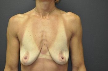 Breast Lift by Dr. Andrew Smith — before and after