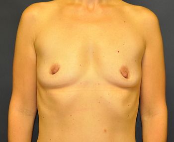 Breast Augmentation before and after - before