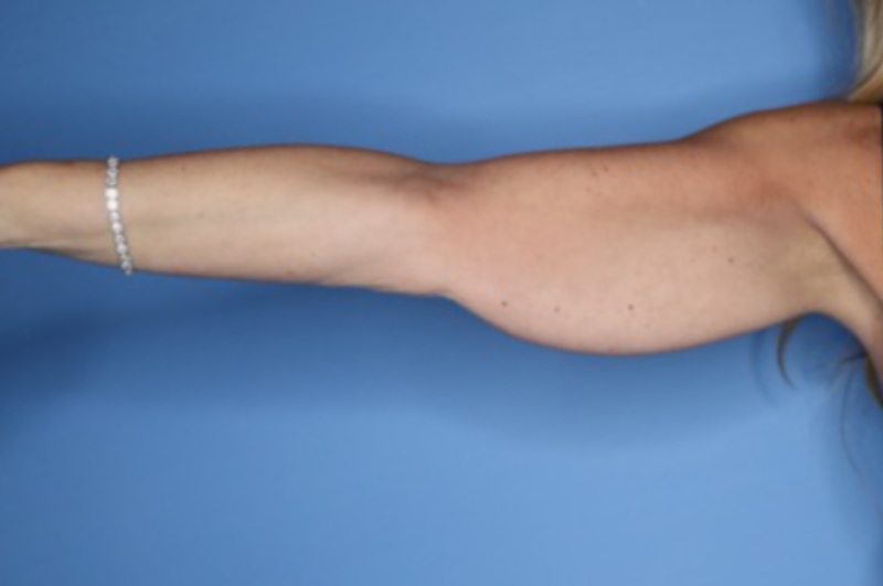 Arm Lift before and after - before