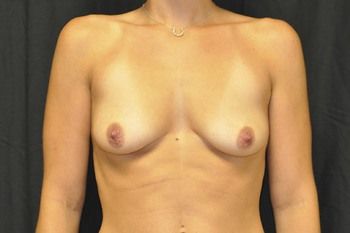 Breast Augmentation before and after - before