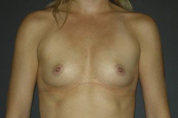 Breast Augmentation before and after - before