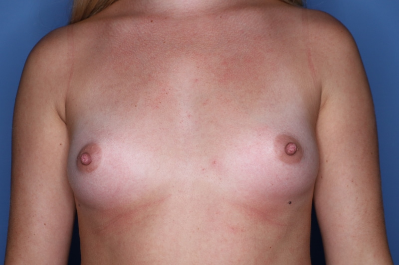 Breast Augmentation before and after - before