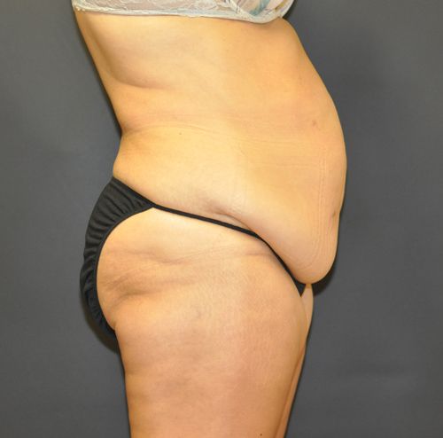 Tummy Tuck before and after - before