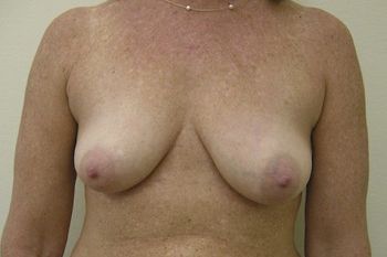 Breast Lift by Dr. Andrew Smith — before and after