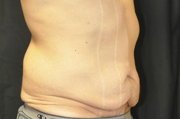 Tummy Tuck before and after - before