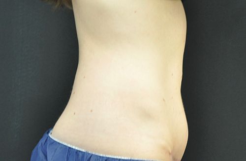 Procedure before and after - before