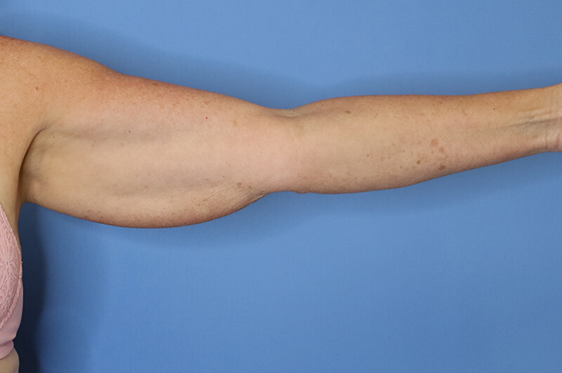 Arm Lift before and after - before