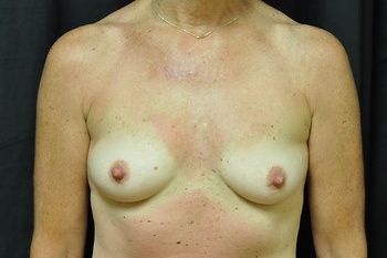 Breast Augmentation before and after - before
