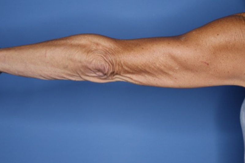 Arm Lift before and after - before