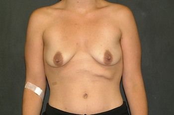 Breast Lift by Dr. Andrew Smith — before and after