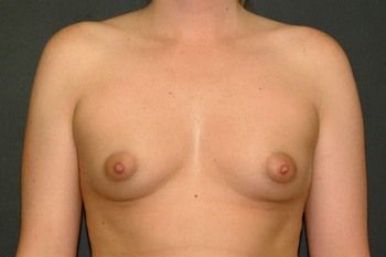 Breast Augmentation before and after - before