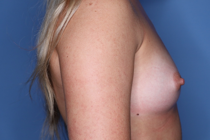 Breast Augmentation before and after - before
