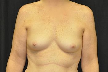 Breast Augmentation by Dr. Andrew Smith — before and after