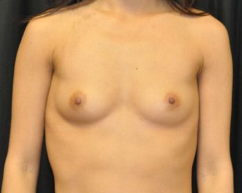 Breast Augmentation before and after - before