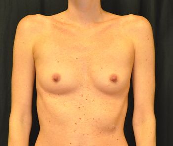 Breast Augmentation before and after - before