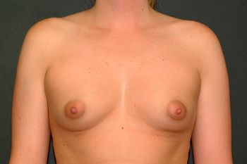 Breast Augmentation before and after - before
