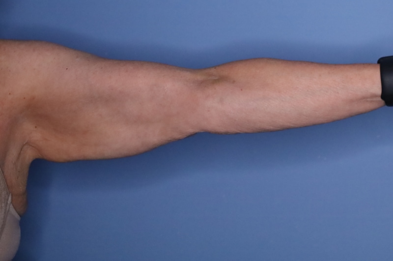Arm Lift before and after - before