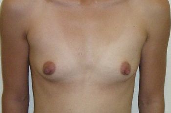 Breast Augmentation before and after - before