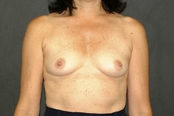 Breast Augmentation before and after - before