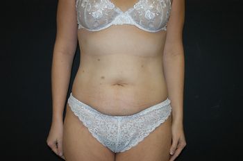 Procedure before and after - before