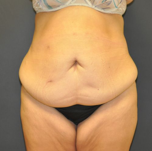 Tummy Tuck before and after - before