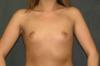 Breast Augmentation before and after - before