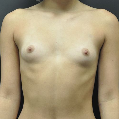 Breast Augmentation before and after - before