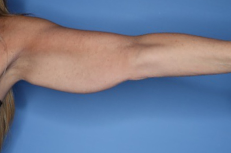 Arm Lift before and after - before