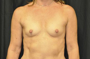 Breast Augmentation before and after - before