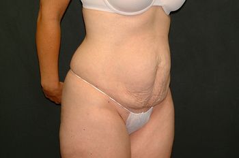 Tummy Tuck before and after - before
