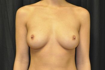 Breast Augmentation before and after - before
