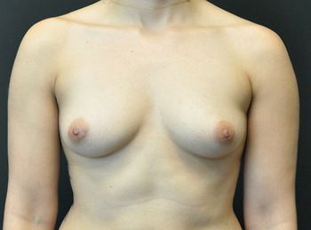 Breast Augmentation before and after - before