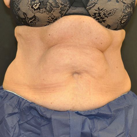 Procedure before and after - before