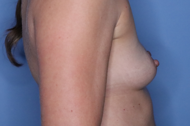 Breast Augmentation before and after - before
