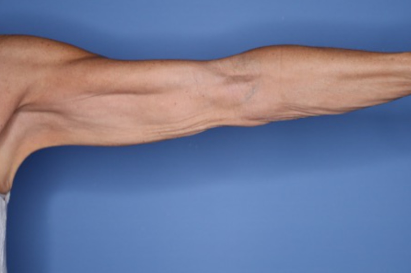 Arm Lift before and after - before