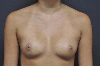 Breast Augmentation before and after - before