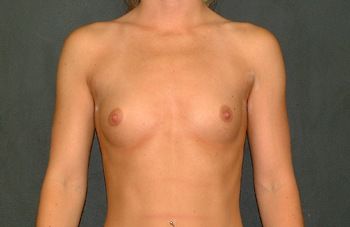 Breast Augmentation by Dr. Andrew Smith — before and after