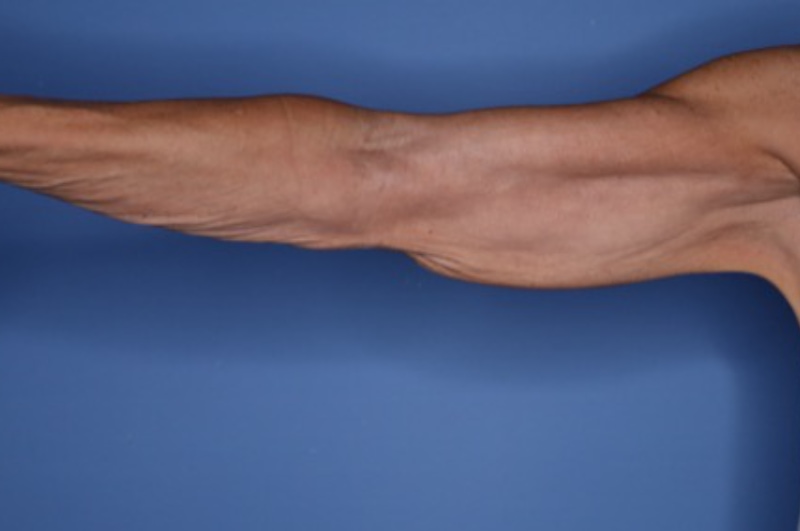Arm Lift before and after - before