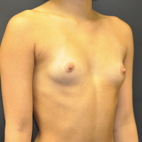 Breast Augmentation before and after - before