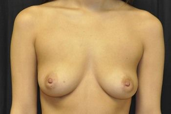 Breast Augmentation before and after - before