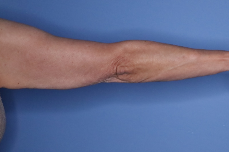 Arm Lift before and after - before